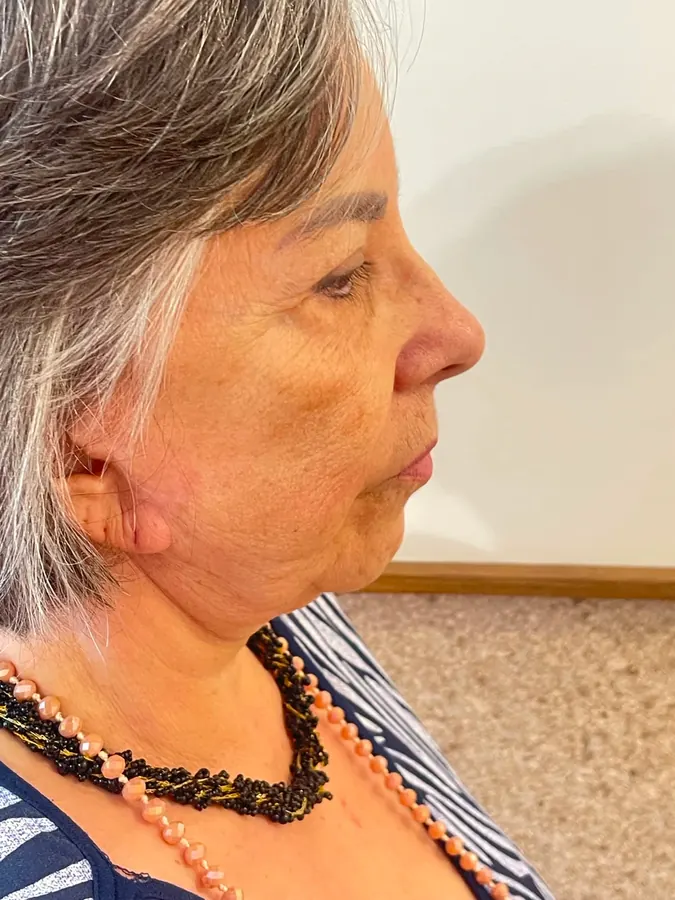 Antes do tratamento com bioestimulador e ultrassom microfocado, vista de perfil