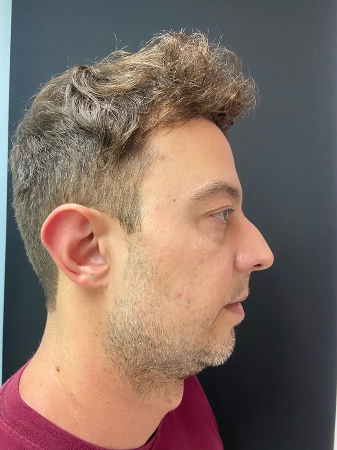 Antes da harmonização facial, vista de perfil