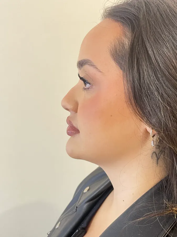 Antes da harmonização facial, vista de perfil