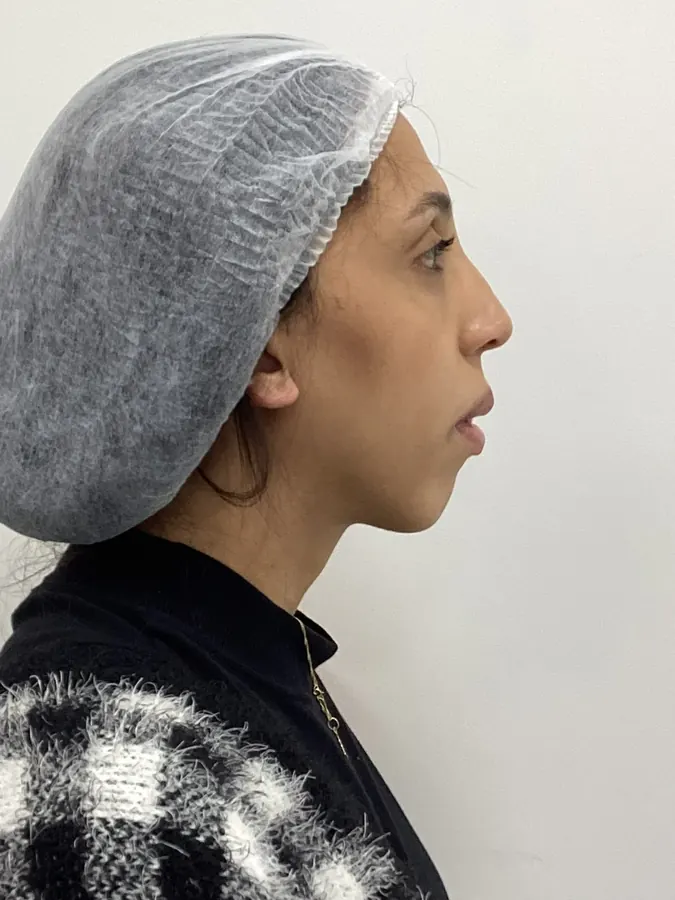 Antes do preenchimento de mento, vista de perfil