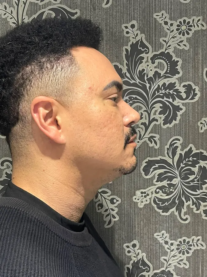 Antes da harmonização facial, vista de perfil