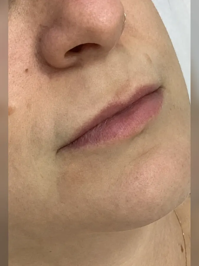 Antes do preenchimento labial