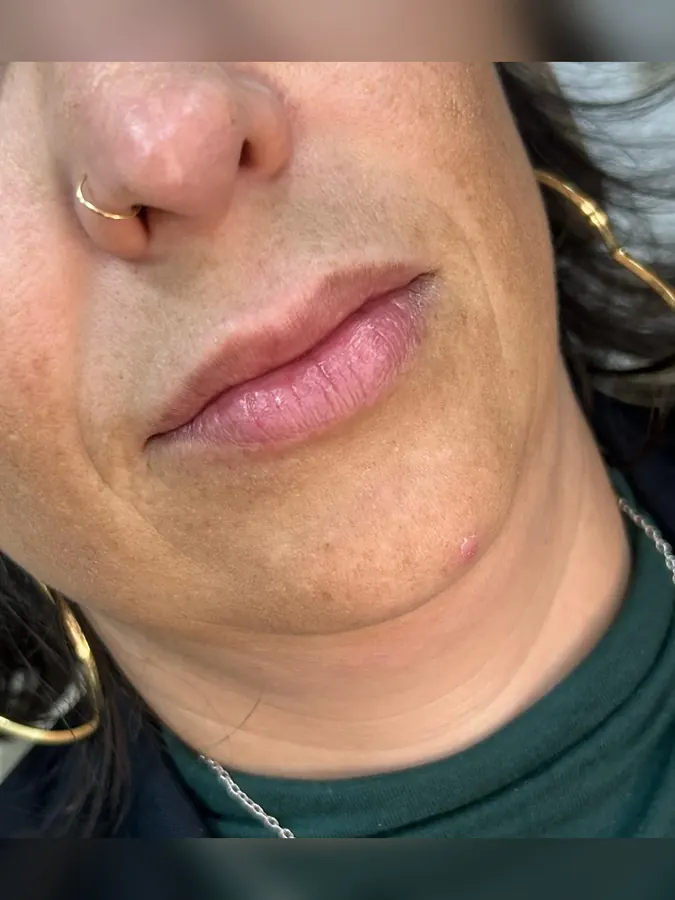 Antes do preenchimento labial, vista aproximada
